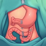 Endoscopic Stapler For Cholecystectomy